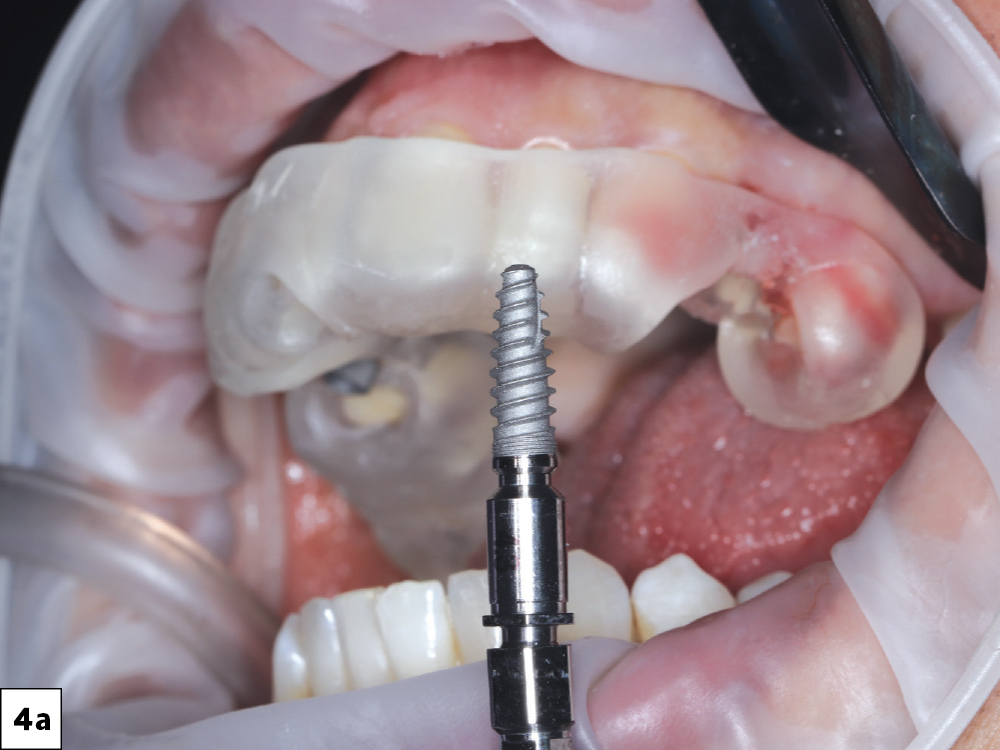 Surgery was performed under local anesthesia with the printed guide securely seated for full control of angulation and depth