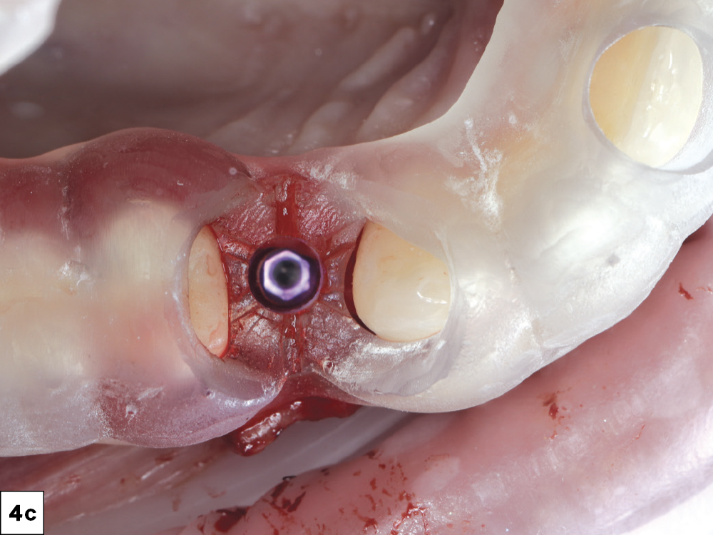 Two Glidewell HT™ Implants (Glidewell Direct; Irvine, Calif.) were placed according to the digital plan, achieving excellent primary stability-c