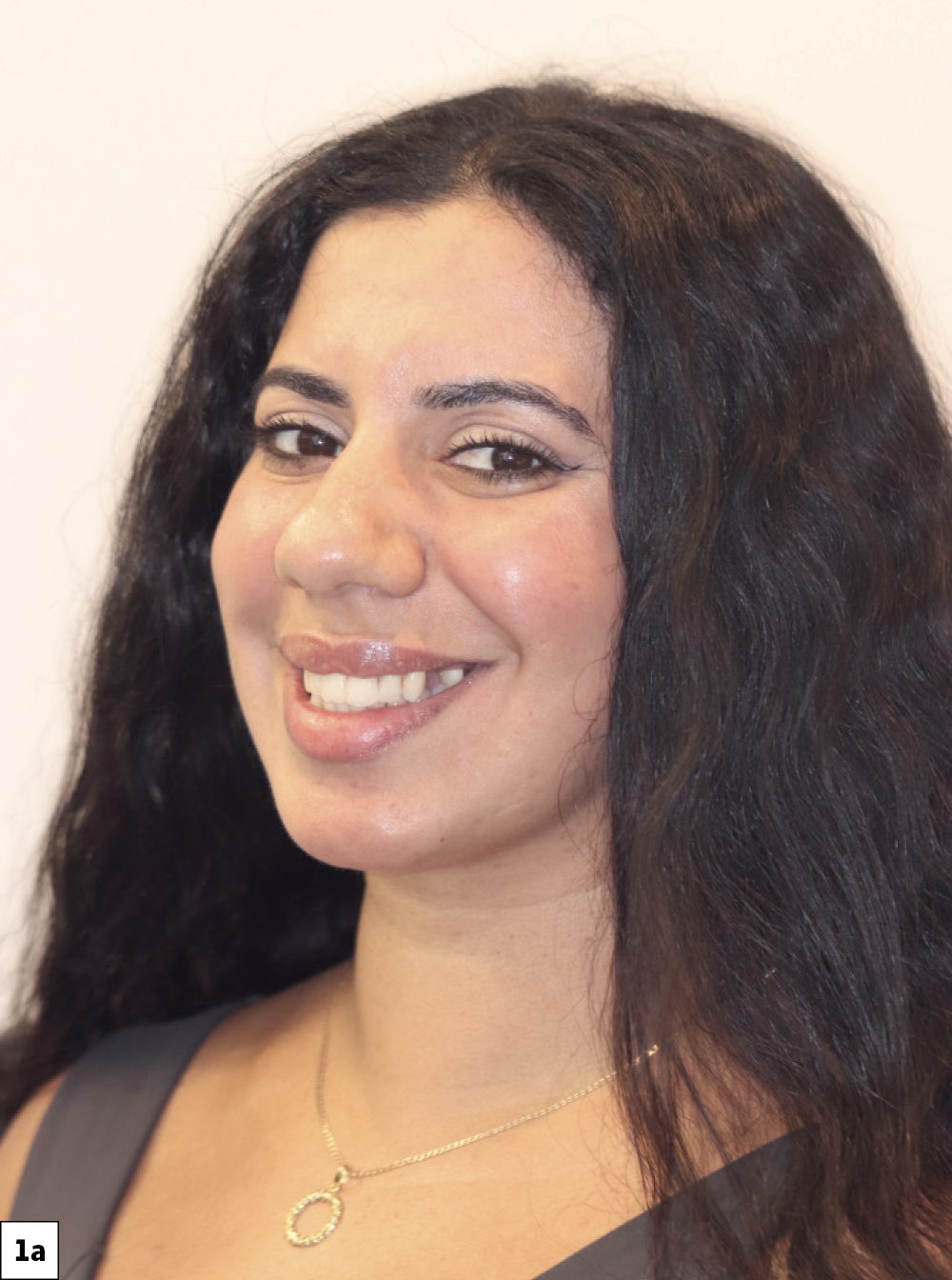 She entered the office that morning missing two premolars and left a few hours later with final, monolithic zirconia restorations that were both functional and esthetically pleasing-a