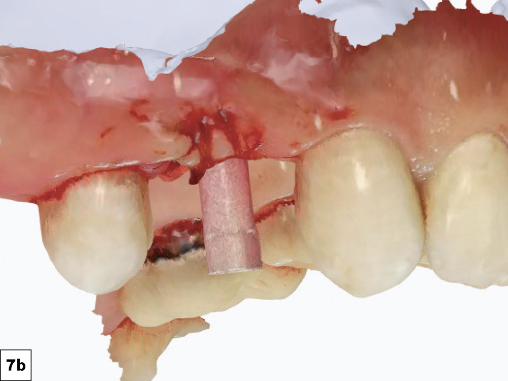 Immediately after placement, scan bodies were threaded in place, and the surgical field was scanned