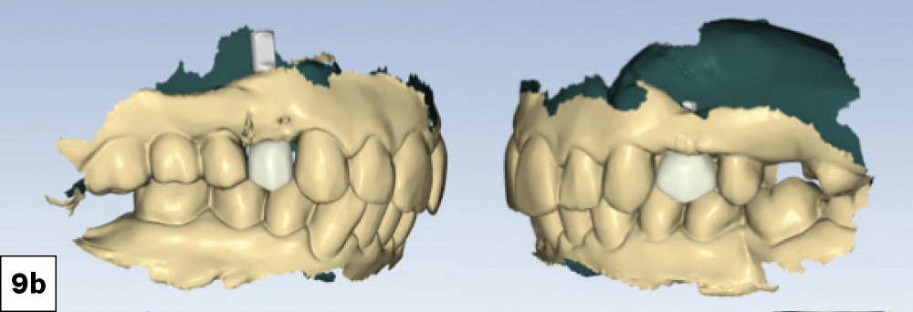 Two screwretained crowns were designed with precise occlusal morphology and customized emergence profiles to support the peri-implant soft tissue-b