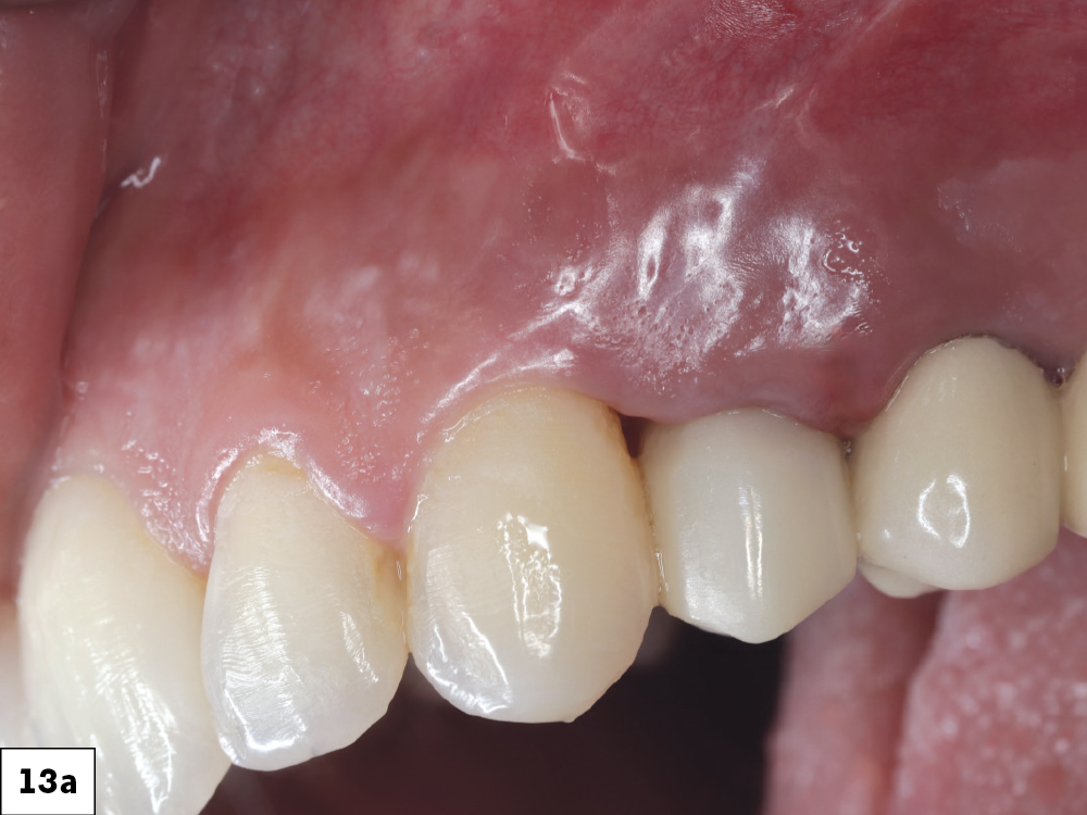 At the one-week follow up, both implants demonstrated excellent integration with healthy peri-implant tissues and no inflammation-a