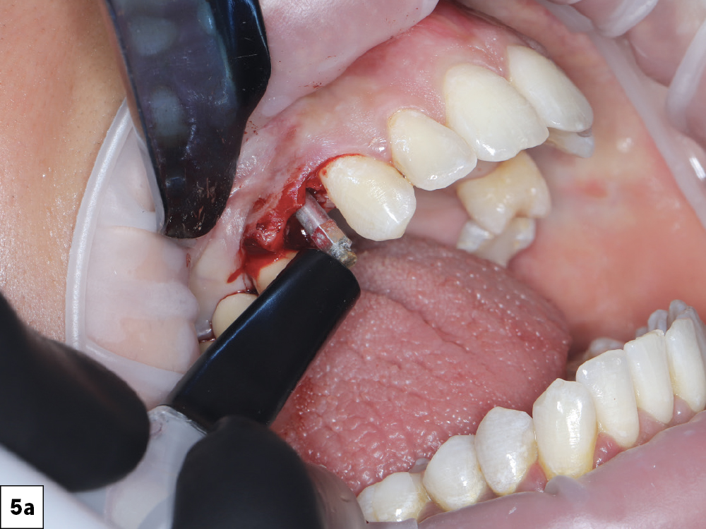 Resonance Frequency Analysis (RFA) was used to confirm an Implant Stability Quotient (ISQ) appropriate for immediate loading