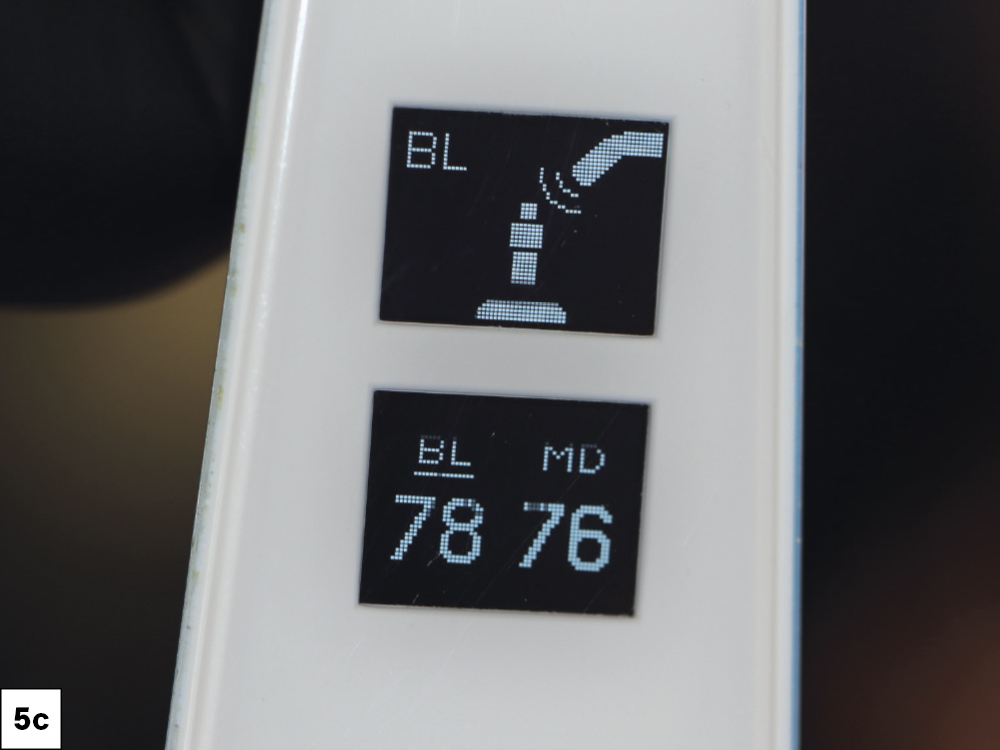 Resonance Frequency Analysis (RFA) was used to confirm an Implant Stability Quotient (ISQ) appropriate for immediate loading-c