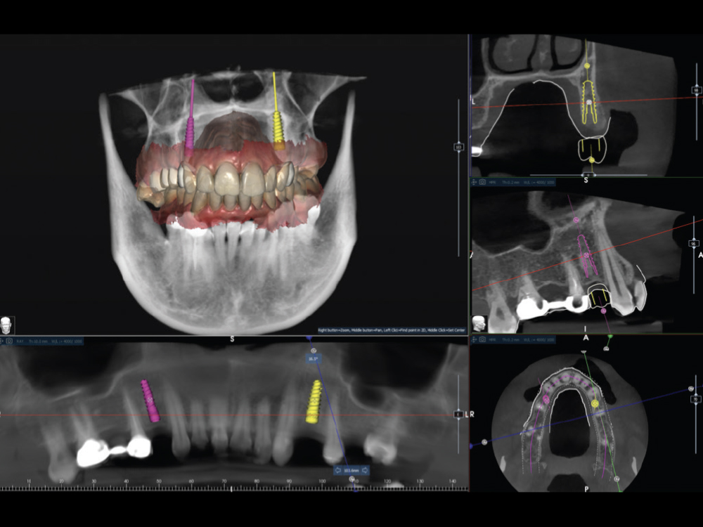Comprehensive records were obtained, including a CBCT scan and a full-arch intraoral scan