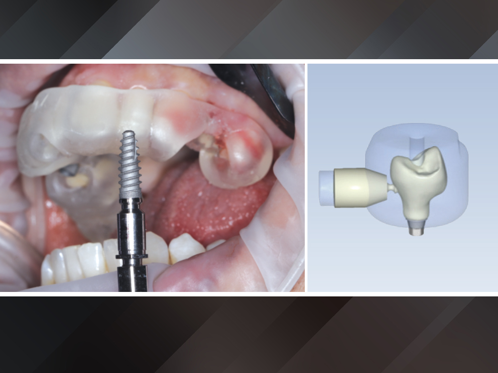 Same-Day Screw-Retained Zirconia Restorations