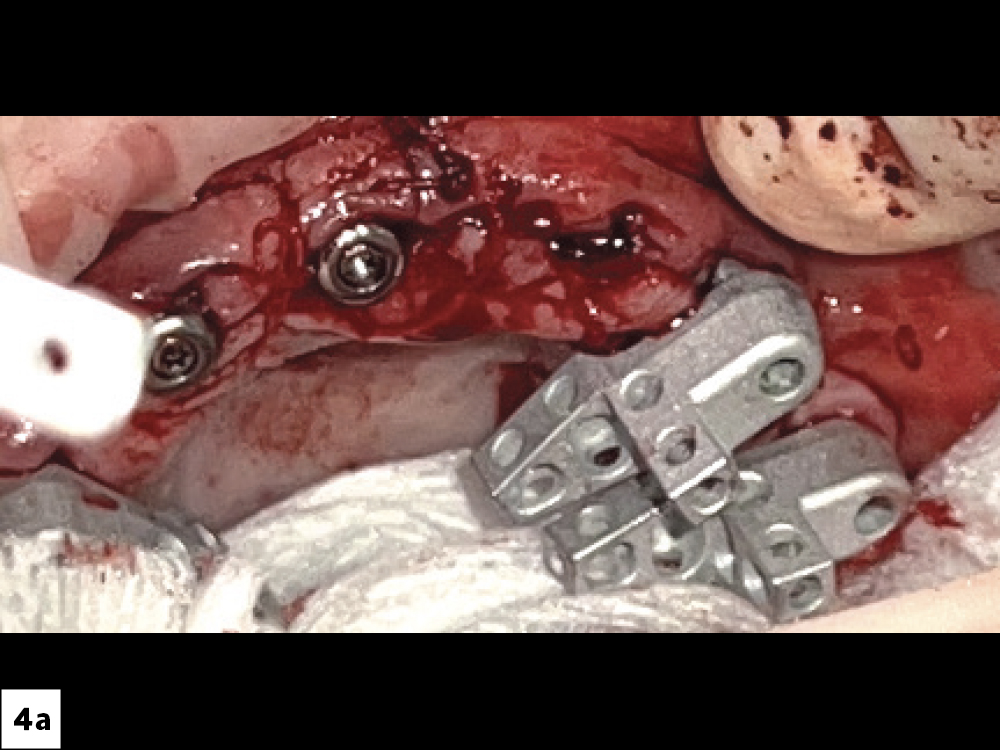 Scan Bodies on Multi-Unit Abutments