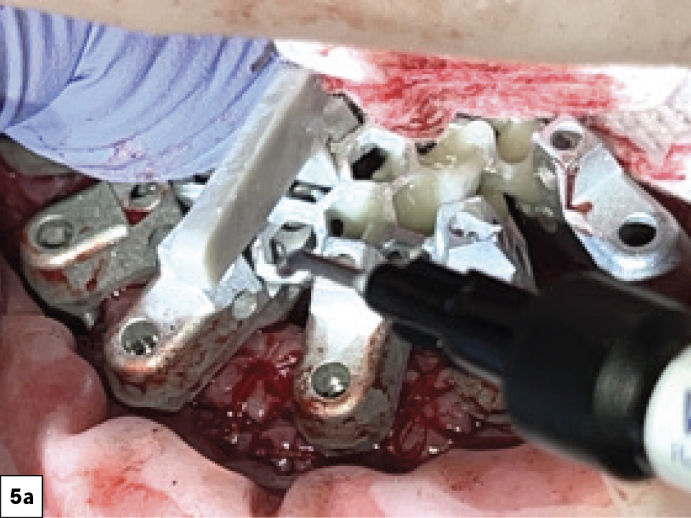 OptiSplint Carried Intraorally