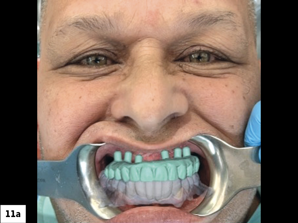 Facial Alignment for Smile Design