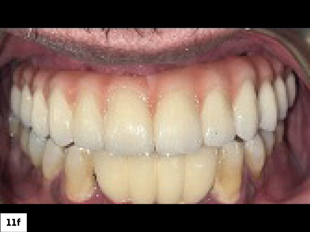 Completed Full-Arch Restoration