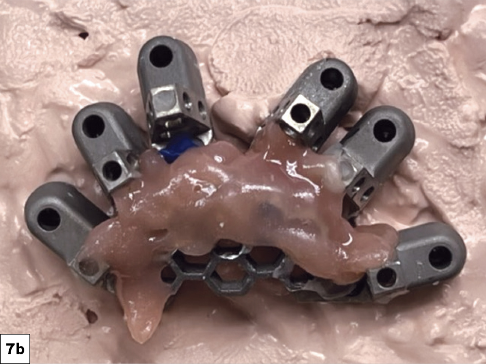 OptiSplint Master Model