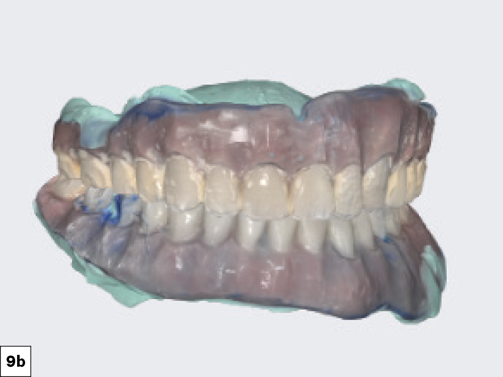 Capturing Healing Abutments