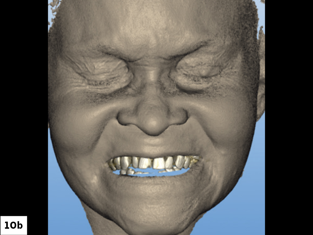 3D facial scan