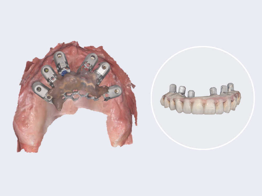 Simplifying Digital Scanning for Full-Arch Implant Restorations