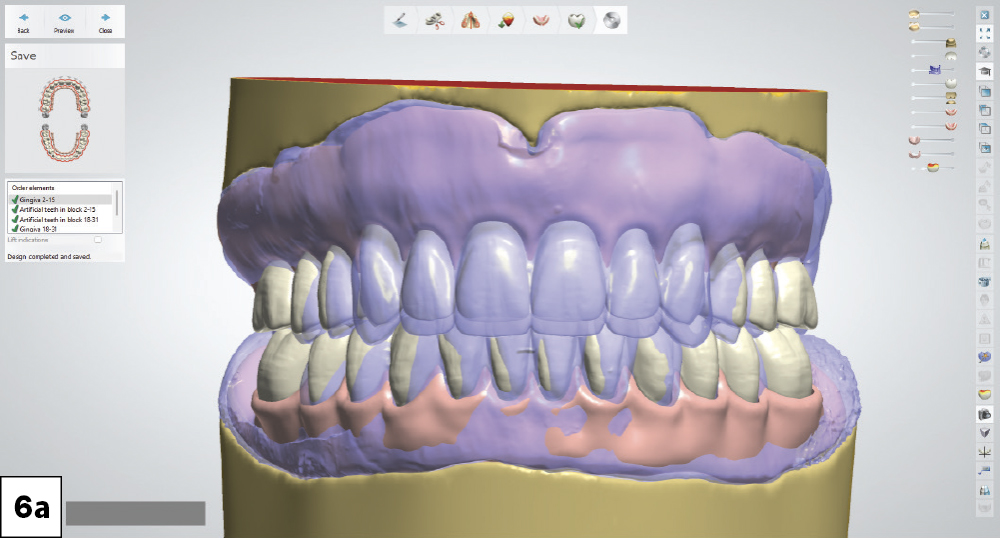 Digital design modifications were performed on both the maxillary and mandibular dentures