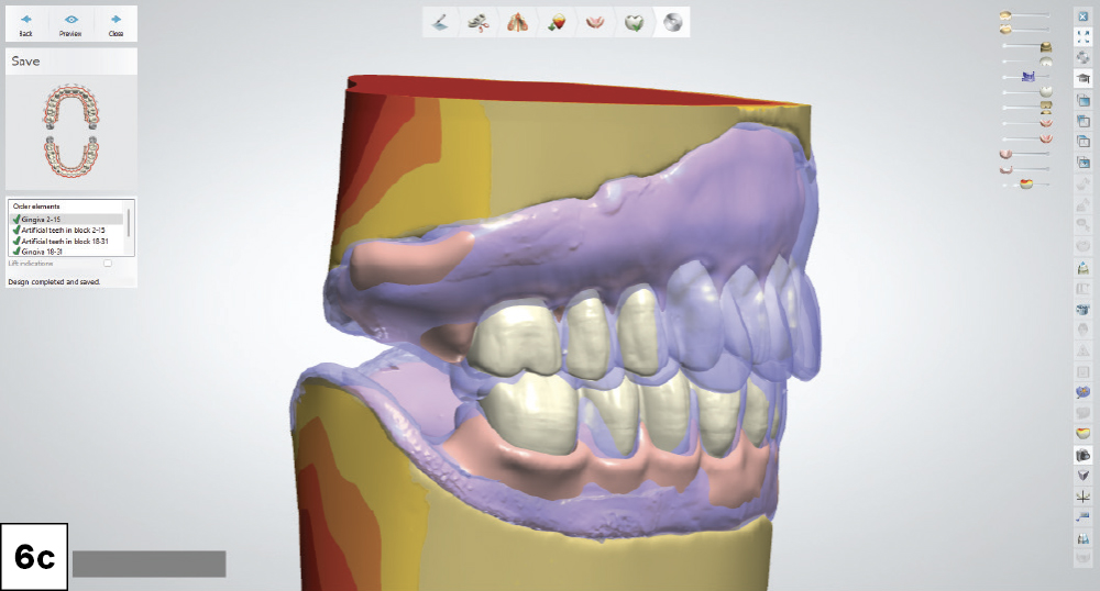 Digital design modifications were performed on both the maxillary and mandibular dentures