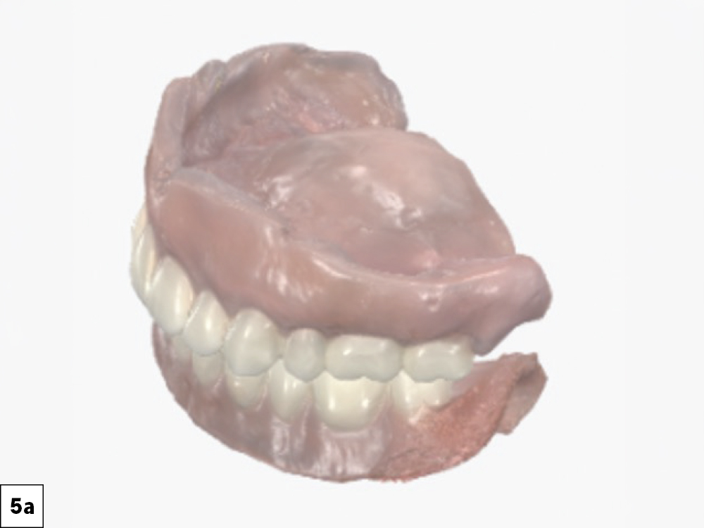 The immediate dentures were relined utilizing the reference denture workflow. A 360-degree extraoral scan of each denture was captured. 