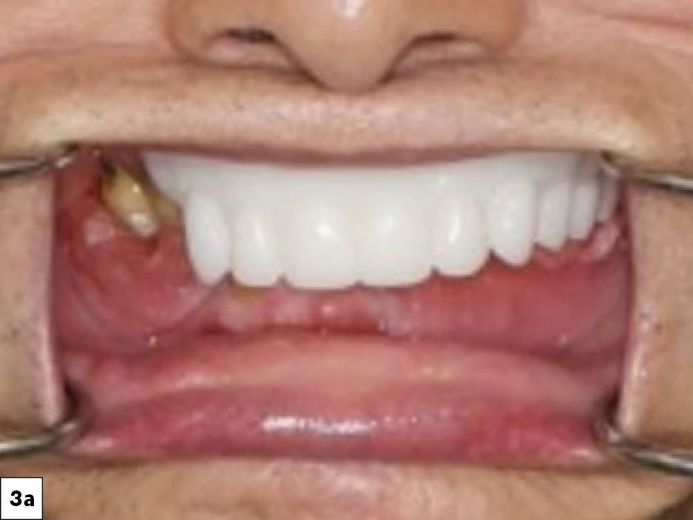  The custom bite blocks helped determine the proper vertical dimension of occlusion and centric relation position prior to immediate denture fabrication.