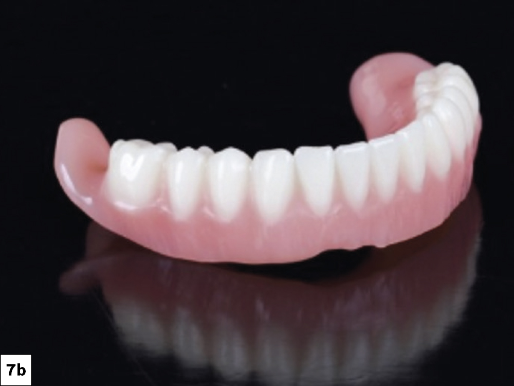 The completed 3D-printed definitive Simply Natural™ Digital Dentures from Glidewell were fabricated using a proprietary base and teeth resin.