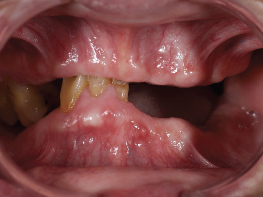 Initial presentation showed partially edentulous maxillary and mandibular arches with compromised tooth position and occlusal relationship that required extraction and complete denture rehabilitation.