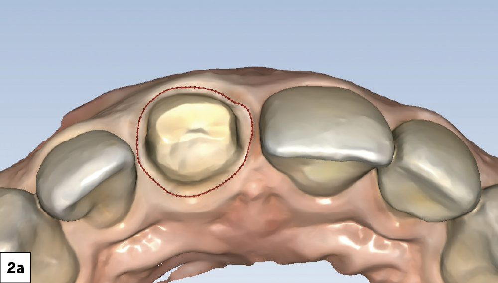 After eliminating undercuts, ensuring optimal clearance from the opposing teeth, and rounding the internal line angles, the case was ready for intraoral scanning