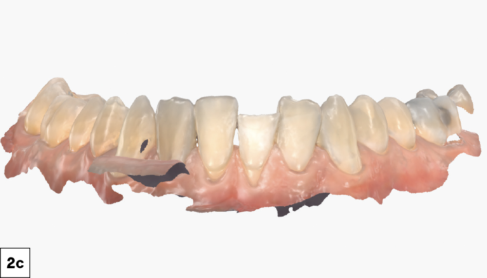 The objective was to capture contaminant-free scans with clearly exposed finish lines while fully capturing neighboring teeth and proximal contact areas.