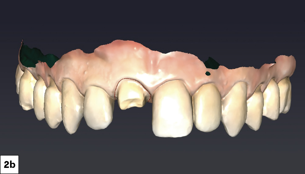 Full-arch digital impressions were obtained using the fastscan.io™ Scanning Solution featuring Medit® i900. 