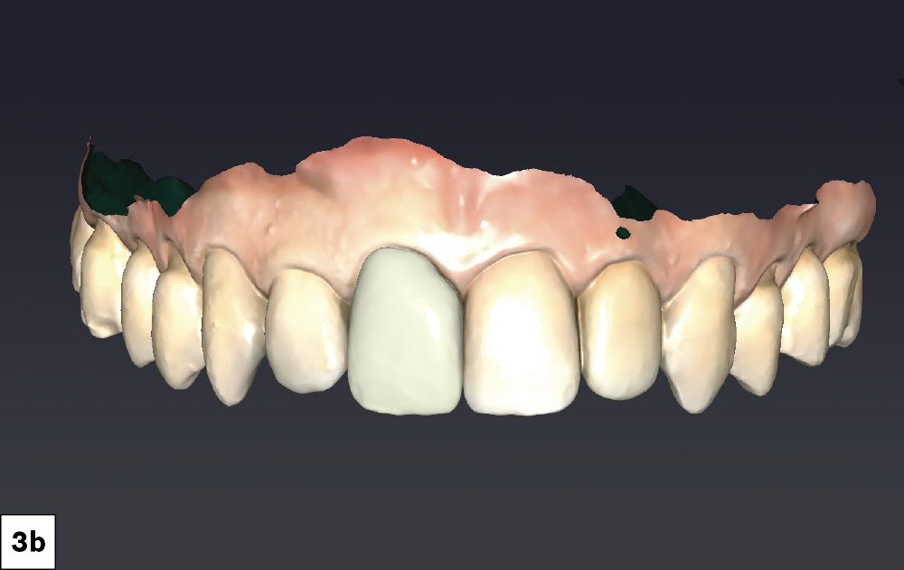 I utilized the fastdesign.io mirror function to create restorative designs that establish symmetrical contours between teeth #8 and #9 as well as for #24 and #25. I also verified proximal contacts and occlusion prior to milling.