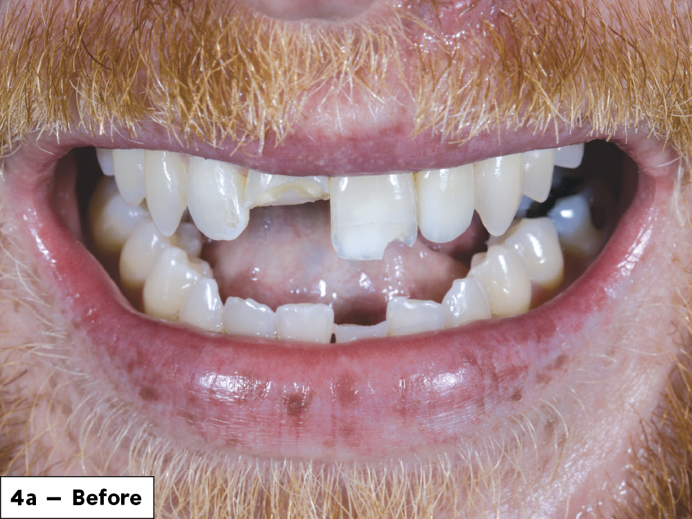 We were able to successfully restore Gregory’s smile in one visit