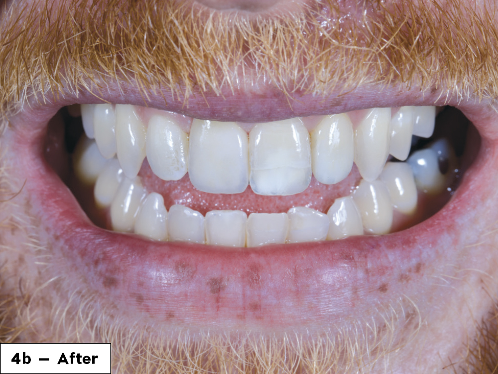 We were able to successfully restore Gregory’s smile in one visit