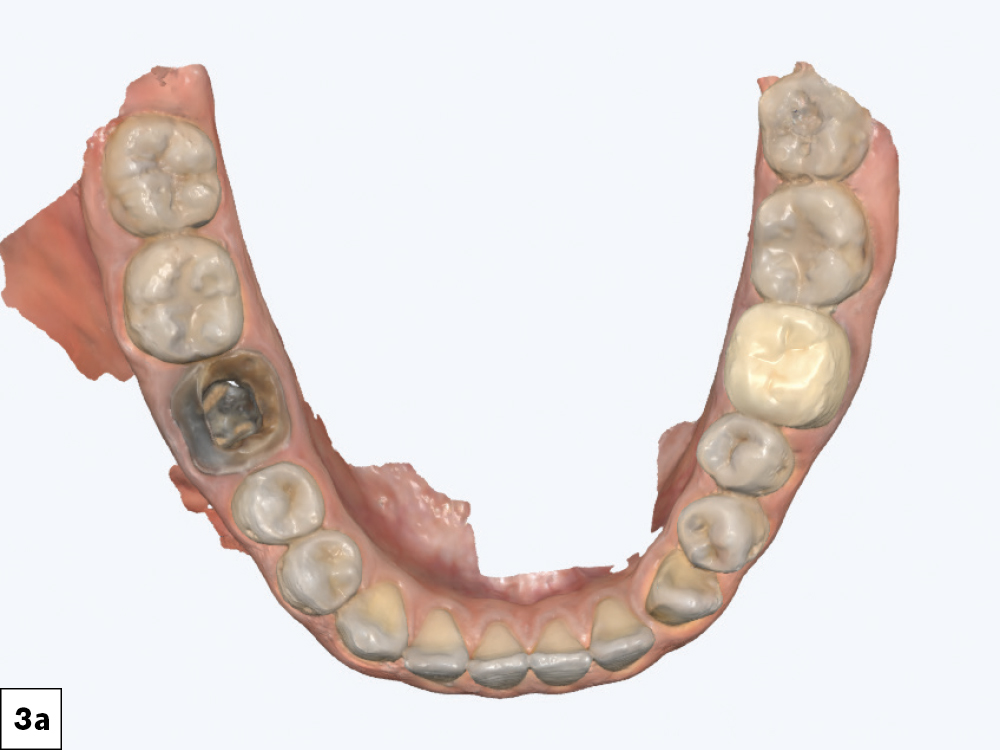 Intraoral scans were taken using the fastscan.io Scanning Solution featuring Medit i900