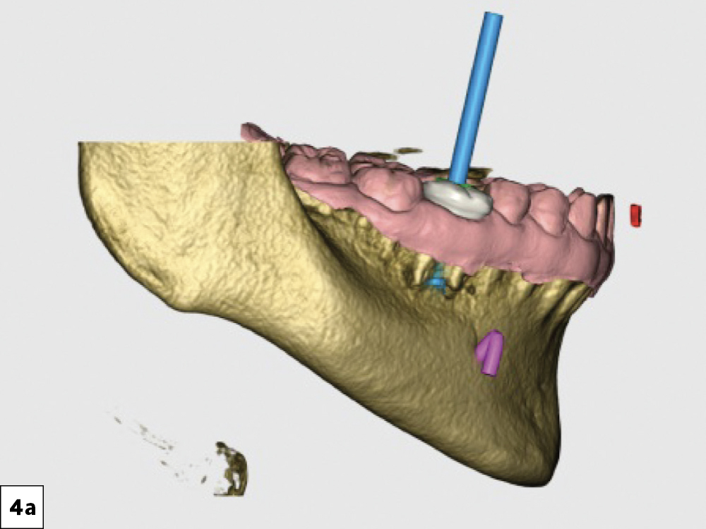 he approved digital treatment plan indicated exact implant location and confirmed there was adequate bone