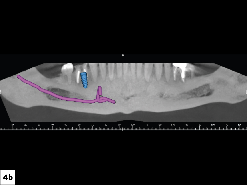 The approved digital treatment plan indicated exact implant location and confirmed there was adequate bone to place a  5 × 11.5 mm Glidewell HT™ Implant