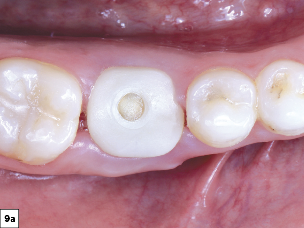 Two-week follow-up showed excellent resolution of the surgical site.