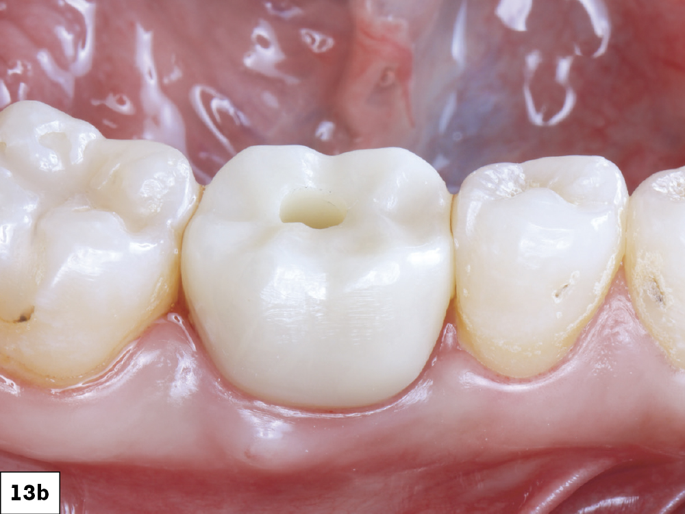 The BruxZir SRC was seated, torqued to 35 Ncm, and the screw access sealed with Teflon tape and composite resin.