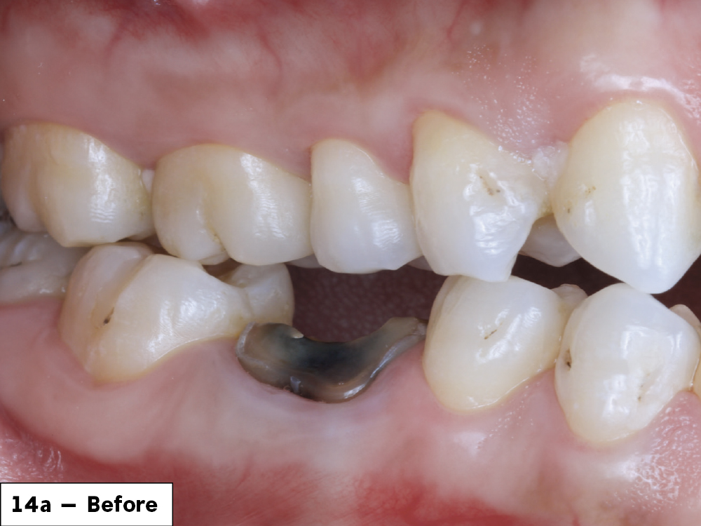 The patient left with a functional and esthetic tooth replacement and was extremely happy with the result.