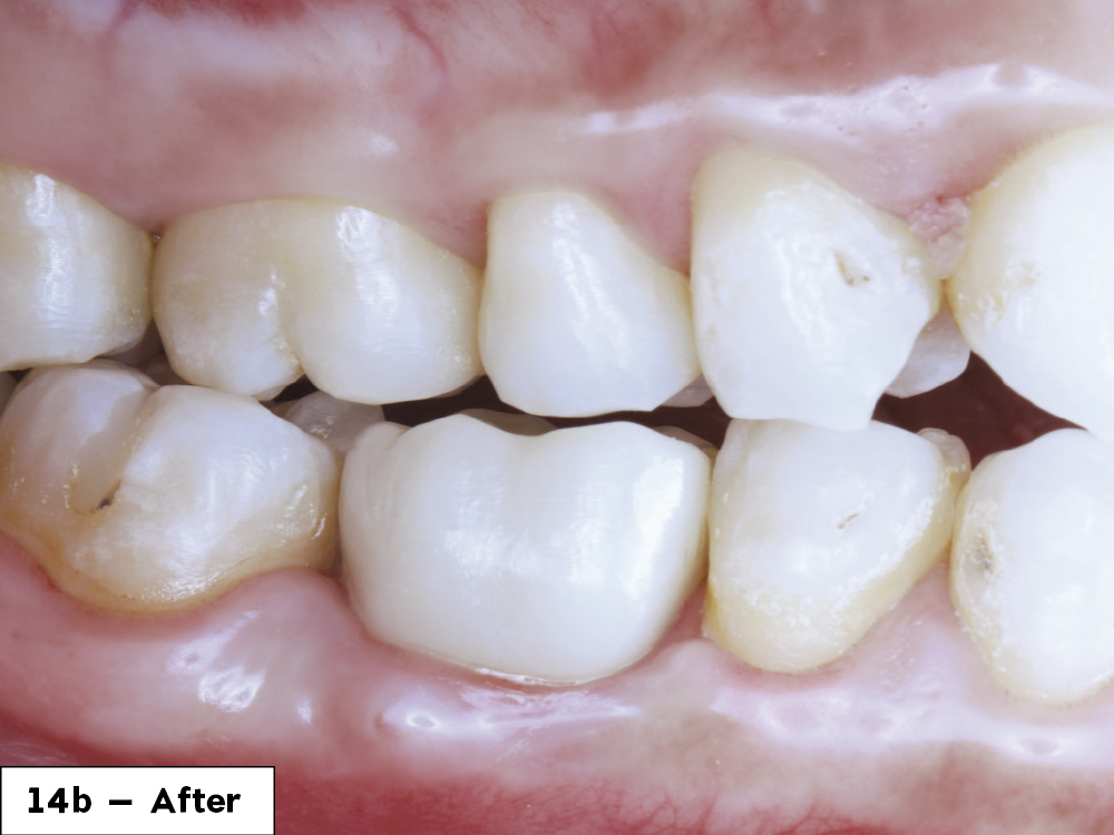 The patient left with a functional and esthetic tooth replacement and was extremely happy with the result.