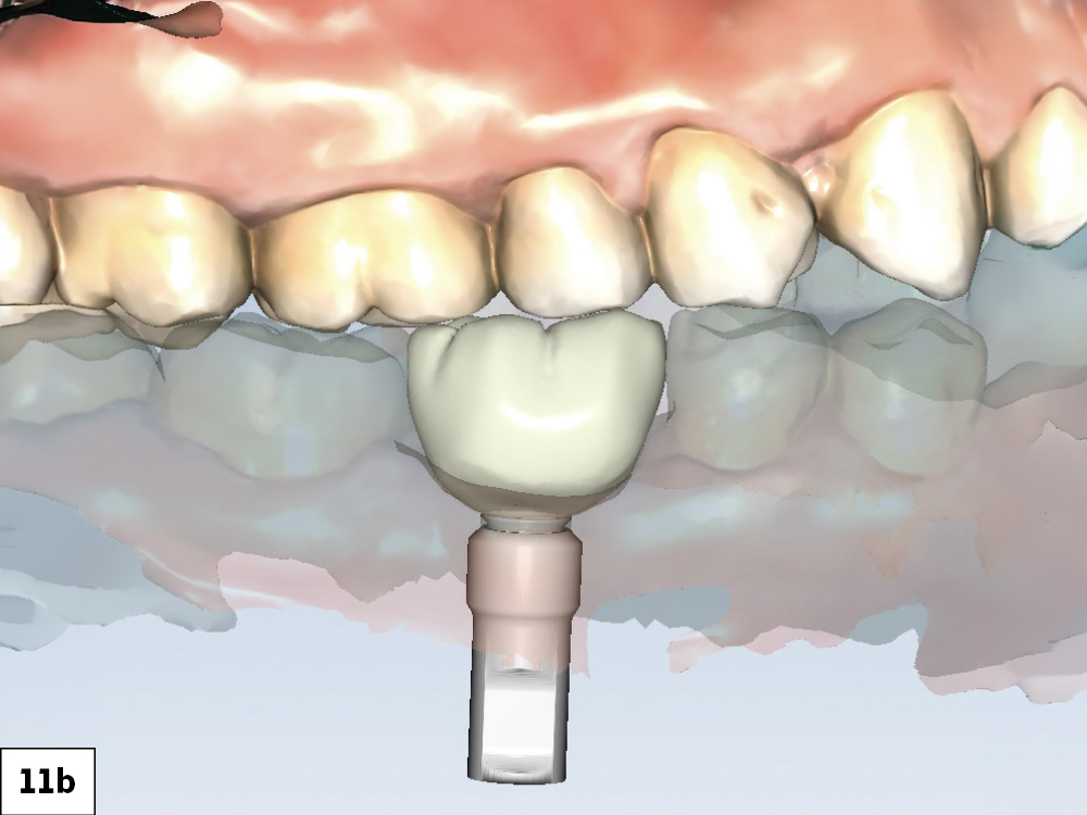 Chairside design using fastdesign.io software helped determine the ideal anatomy of the BruxZir NOW screw-retained crown prior to milling.