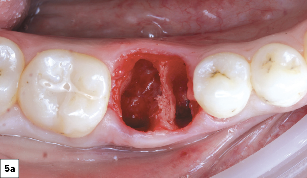 The surgical site was then grafted using Newport Biologics™ Mineralized Cortico/Cancellous Allograft Blend