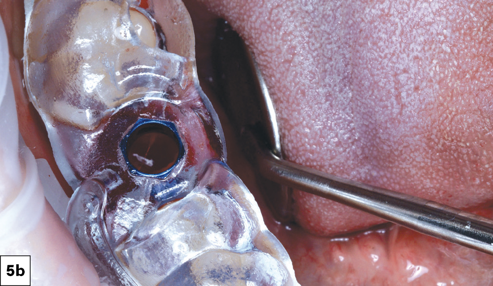 The surgical site was then grafted using Newport Biologics™ Mineralized Cortico/Cancellous Allograft Blend
