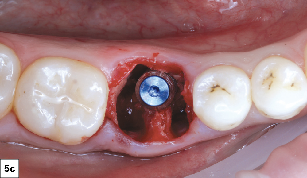 The tooth was carefully extracted and followed by socket debridement and curettage to remove all granulation tissue. 
