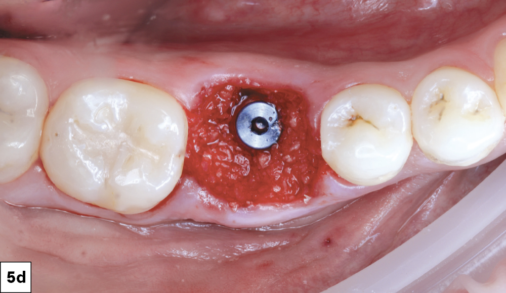 The surgical site was then grafted using Newport Biologics™ Mineralized Cortico/Cancellous Allograft Blend