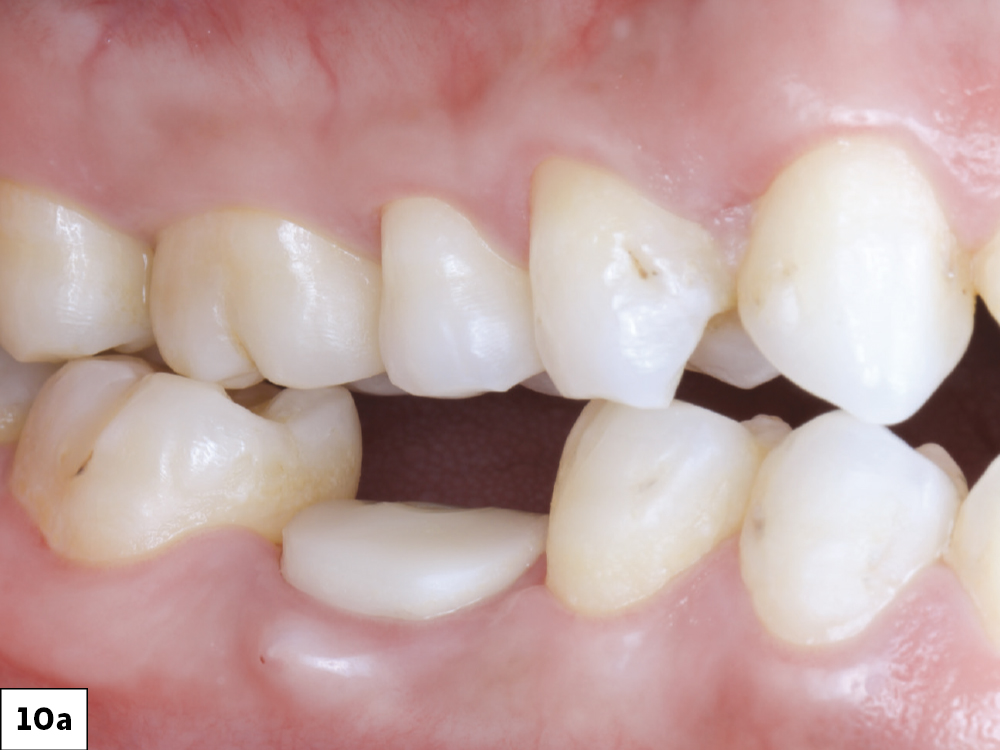 The healing abutment was removed, and a scan body was seated