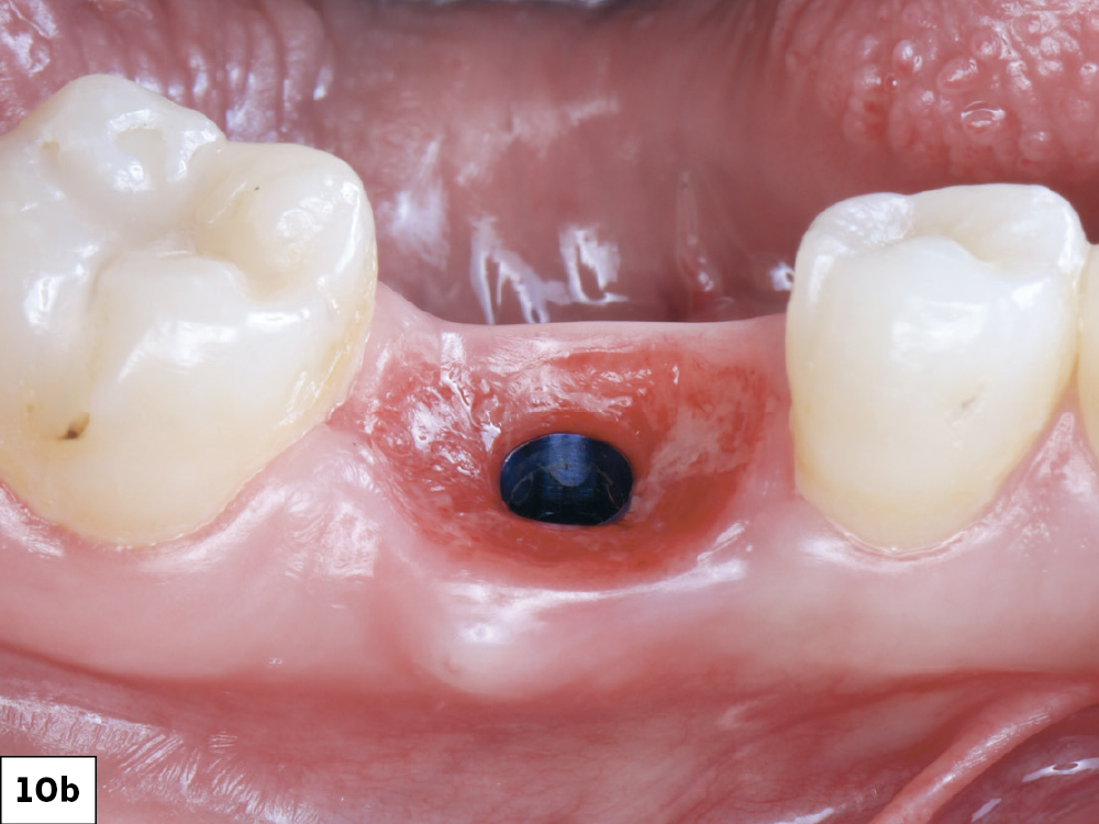 The healing abutment was removed, and a scan body was seated