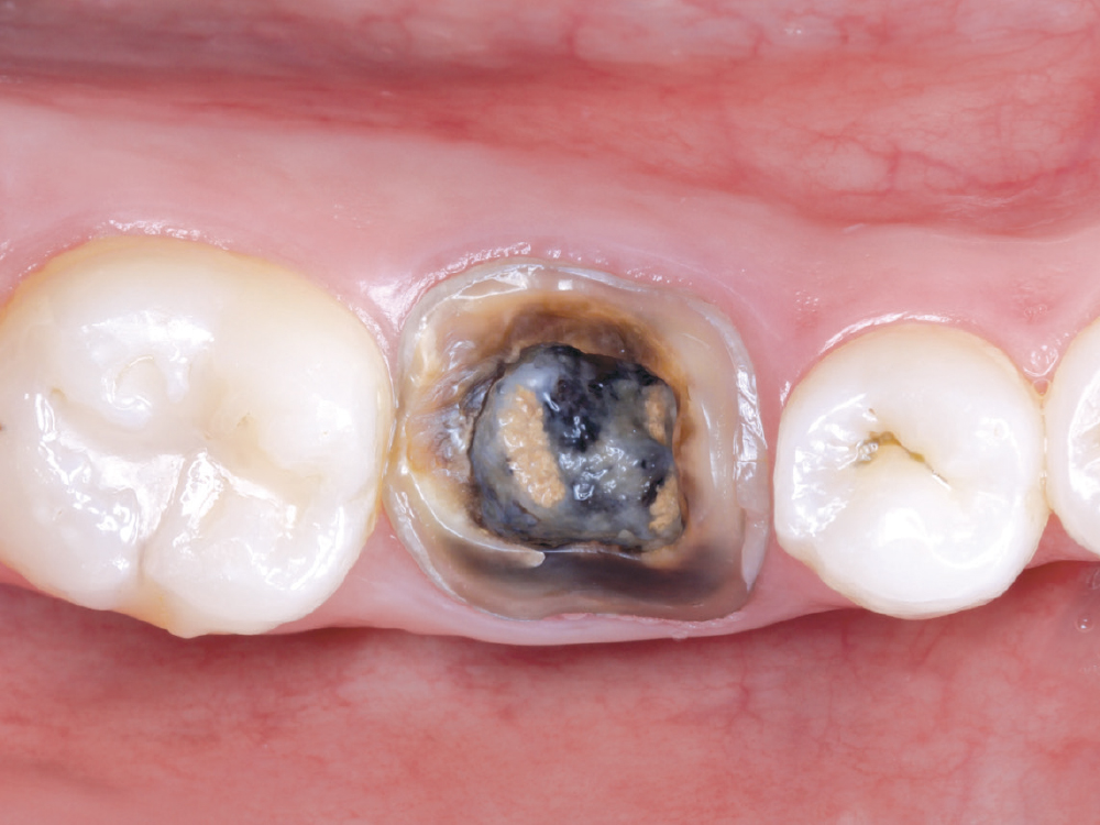 An intraoral scan and CBCT were performed.  Tooth #30 had a missing crown restoration, recurrent caries