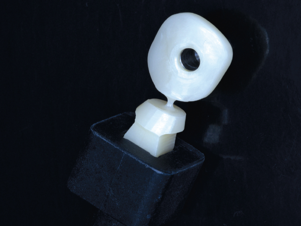  The custom healing abutment was milled chairside in 30 minutes using a BruxZir® NOW Milling Block.