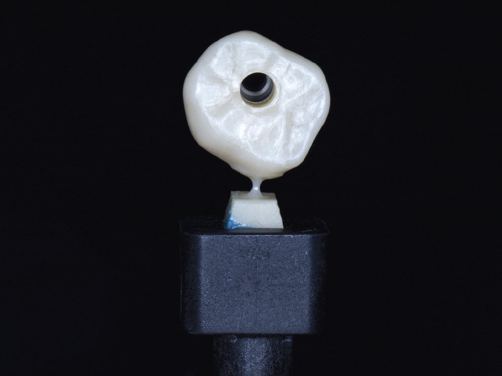  Chairside-milled BruxZir NOW screw-retained crown.
