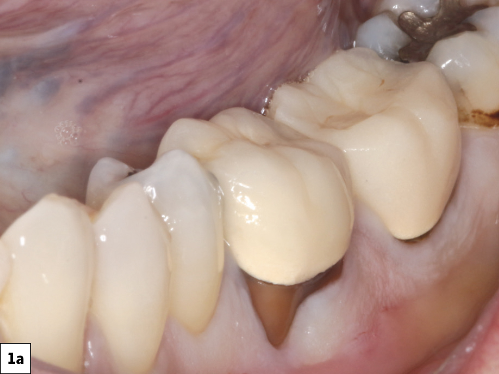When presented with the treatment options, the patient chose a single-unit implant-supported restoration