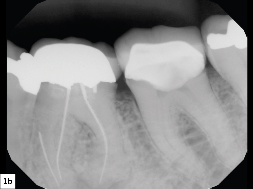 When presented with the treatment options, the patient chose a single-unit implant-supported restoration