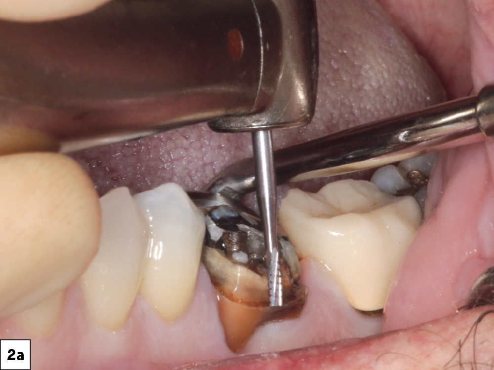  After buccal vestibular infiltration and a lingual PDL injection, a mesio-distal root section was performed through the furcation